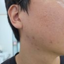 보노안경 | 모낭염 좁쌀 여드름 없애는 법, 대전 에스테틱영에서 답을 찾다