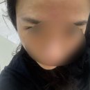 청주 리쥬란HB+ 2cc 1회차 내돈내산 후기 (당일 ~ 3일후)