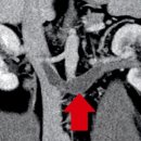 호두까기 이미지