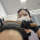 인하대 탈모관리 설레인라인 후기| 헤어라인 두피관리 모100생장술 받은 솔직후기