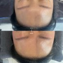 더마리턴5 | 중랑구피부관리, 더마리젠리턴솔루션 에스테티아 망우점 솔직 후기
