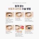아름다운세상피부과 Daum카페
