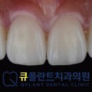 보일치과기공 네이버블로그
