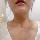 대구 편평사마귀, 듀오덤 필요없는 얼굴+목 무제한 제거 한의원 추천