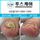 서산내성발톱 당진내성발톱 으로 유명한곳 TV조선방송출연