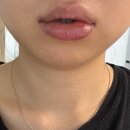 안울진치과의원 | 호매실동 치과추천 - 점액낭종 제거수술 후기 [수원이로운치과의원] (내돈내산)