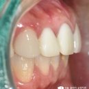 미아사거리 치과 에서 부분 교정 치료 과정으로 삐뚤어진 아랫니 가지런히 배열해드린 사례