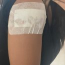 대지약국 | 타투제거 3회차 리얼후기 | 피코케이