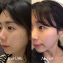 기업은행 광적점 옆 도로 | 프리미엄 청담피부과 포텐자 스킨부스터 영부스터 내돈내산 후기