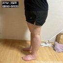 상상하지 말고 시작하자! 팔뚝 허벅지 종아리 지방분해주사 가능한 의원 5일차 기록 솔직 후기