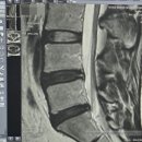 청구 | 허리디스크 요추 MRI 입원 및 실손보험 청구 후기