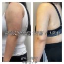 작은팔 | 예신 필수 팔지방흡입 한달 차 후기 팔지흡관리 꿀팁까지!