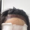 내돈내산 절개 여자 헤어라인 모발이식 후기 - 수면마취, 고통, 부작용, 수술후기(D-day/2024.3.6)