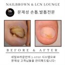 (주)온빛링크 | 광교무좀발톱 때문에 아파하셨던 발톱 네일브라운에서 문제성발톱 깔끔하게 스케일링 해드렸습니다!