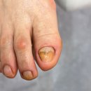 문제성 손, 발 오감네일 이미지