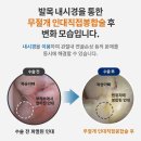 발목인대부분파열 수술 후기 찾아보며 버텼다면 이젠 이미지