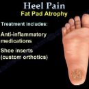 Heel Pain and plantar fascitis 이미지