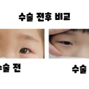 파티마유치원 | 대구파티마병원 유아 간헐성 외사시 수술 후기 완벽정리