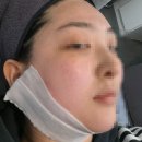 울쎄라 말고 쿨소닉+인모드 1차 시술 후기