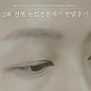 눈썹달 | 에이브천안왁싱앤눈썹 천안 불당동 눈썹문신제거 한달 후기