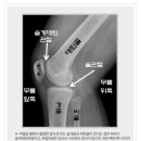 무릎 구부릴때, 두두둑 소리가 난다면? 이미지