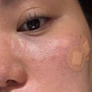 고주파리프팅 을지로피부과한의원 / 동안침 솔직후기 / 피부 처짐으로 탄력 재생하기