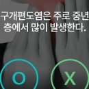 침삼킬때 목아픔 구개편도염과 만성편도염에 대하여 이미지