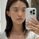 올림픽 LDM | 올림픽파크포레온 둔촌동피부과 LDM 물방울리프팅 수분관리 후기 효과