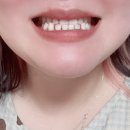 퍼플솔루션 | 궁금했던 셀프 퍼플이미백치약 후기 하얀이 퍼플e 내돈내산
