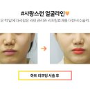아르뜨성형외과 네이버블로그