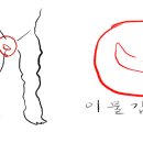 사타구니 이물감, 혹은 통증 치료에 대해 조언을 구합니다. 이미지