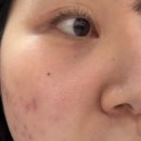 메디스코 | 메디스코 셀프 해초필링 내돈내산 솔직 후기 ㅣ 붉은여드름 흉터 고민