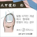 네일죤부산 | 경기 안양시 네일샵 중에 파고드는 발톱으로 아픈 고생을 떨쳐버릴 수 있는 발톱교정 하는 곳이 있다고...