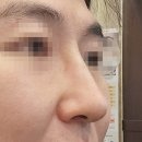 비수술코성형 넥스코성형 후기 | 남자 매부리코, 인상이 걸림돌이 되시나요?