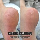 장기역 | [레푸스 김포장기역점] 김포발각질 굳은살 관리후기
