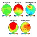동묘뜰 정신건강의학과의원 | ADHD 검사와 콘서타 후기랄까?