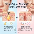 예덕피부관리 | 가로모공 vs 세로모공 원인 진단과 맞춤 관리법