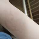 잠실새내역 피부질환 보는 피부과,급성 두드러기 일주일간 후기