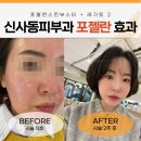 젤란사 | 신사동피부과 포젤란효과 레가토2 레이저 모공축소 추천