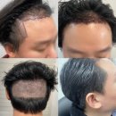 두드림성형외과의원 | 두드림 구렛나루 M자 모발이식 한 달 후기, 가격과 통증은 어떨까