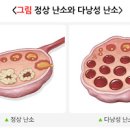 다낭성 난소 증후군 원인 증상 진단 치료 비만 털 이노시톨 이미지