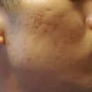 차차한의원 | 여드름전문한의원 미세침 흉터 없앤 찐 후기