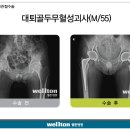 [대퇴골두무혈성괴사] 대퇴골두무혈성괴사란? 이미지