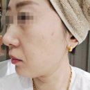 선메디라인의원 | 강남피부과 인모드FX 탄력리프팅 받은 찐 후기(통증,주의할점)