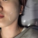 살빼는집 | 슈링크 유니버스 윤곽주사효과 얼굴살 빼는 법 후기