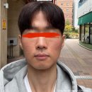 드림피부과의원 | 스노우의원 방문기 3편｜지루성 피부염 피부과 1회차 시술 후 피부 상태 후기