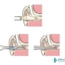 귀에서 물나옴 진물 냄새나는 원인, 대응법 체크 이미지