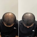 장기동두피문신이 고민이라면