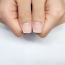 손톱모양 | [인천 손톱교정] 넙데데한 부채꼴 손톱의 반전, 6주 만에 달라지는 손톱모양 리얼 후기!