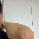 D-22 | 혈액줄기세포 정맥주입 후기 D+22